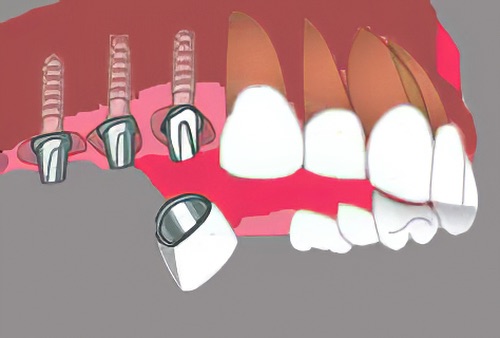 Cabinet dentaire Nimes Implants dentaires